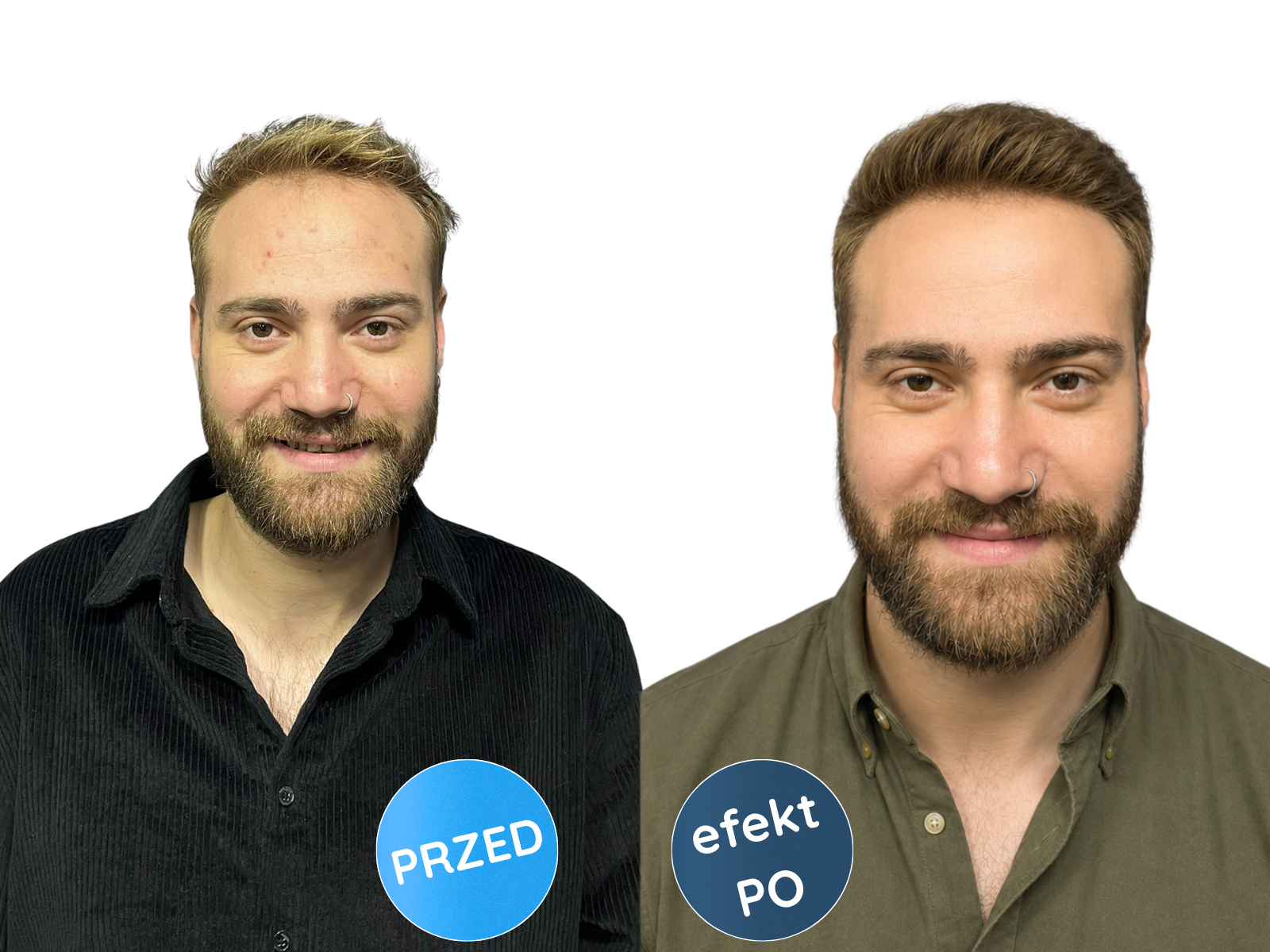 Przed i po: przerzedzenie i pełne włosy, pacjent w koszuli w kratę, Turkus.