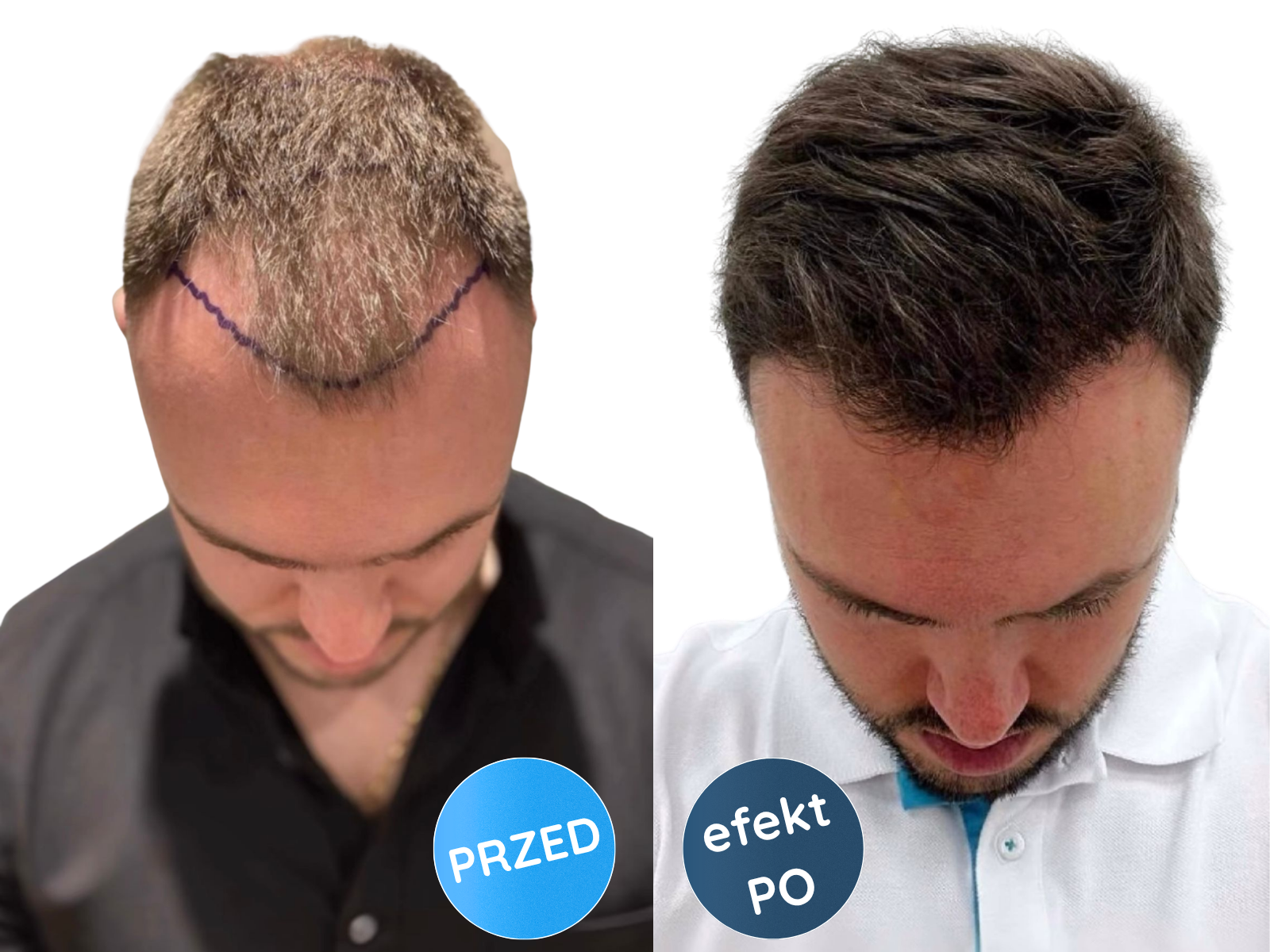 Przed i po: przerzedzenie i pełne włosy, pacjent w koszuli w kratę, Turkus.