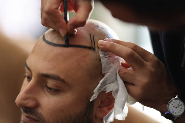 Planowanie naturalnej linii włosów markerem przed przeszczepem w Turkus Hair Transplant Clinic.