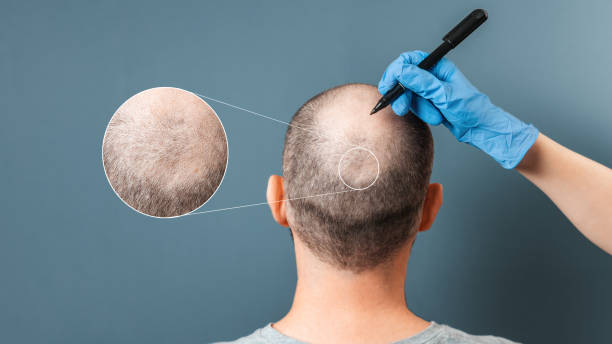 Ocena obszaru dawczego i wypadania włosów podczas konsultacji w Turkus Hair Transplant Clinic, powiększenie skóry głowy.