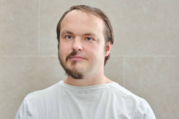 Przeszczep brody, naturalna gęstość w Turkus Hair Transplant Clinic w Polsce.
