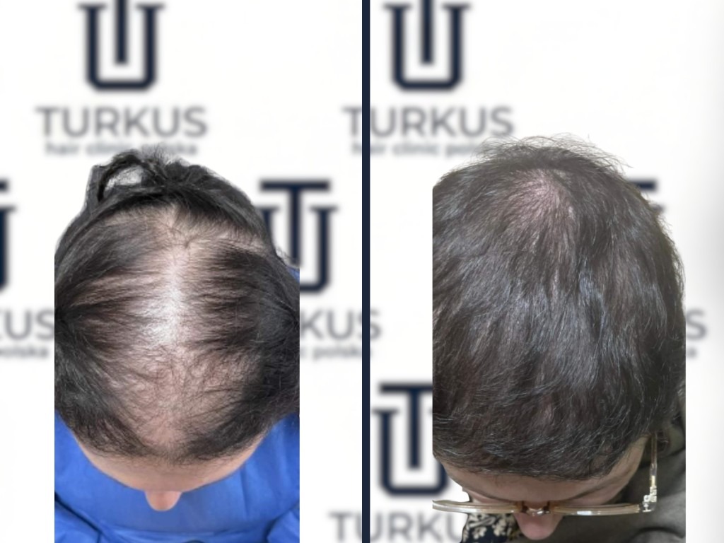 Adam S. przed i po przeszczepie włosów DHI w Turkus Hair Transplant Clinic.