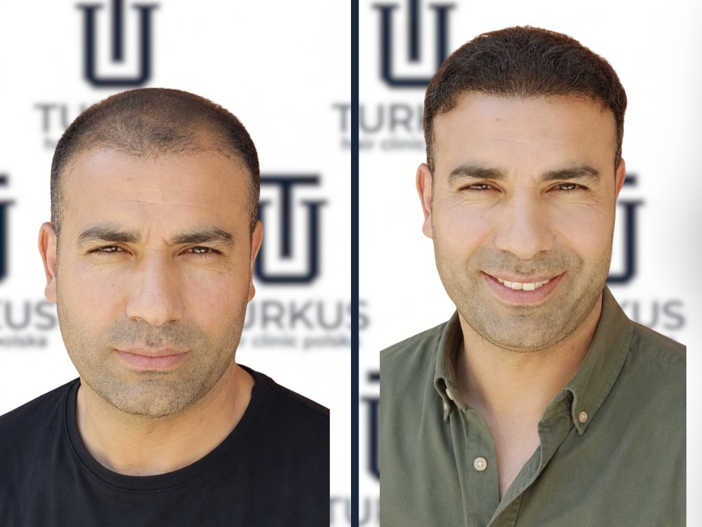Javier M. przed i po przeszczepie włosów FUE w Turkus Hair Transplant Clinic.
