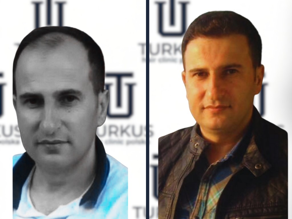 Can Y. przed i po przeszczepie włosów FUE, 4.000 graftów, Norwood 5 w Turkus Hair Transplant Clinic.