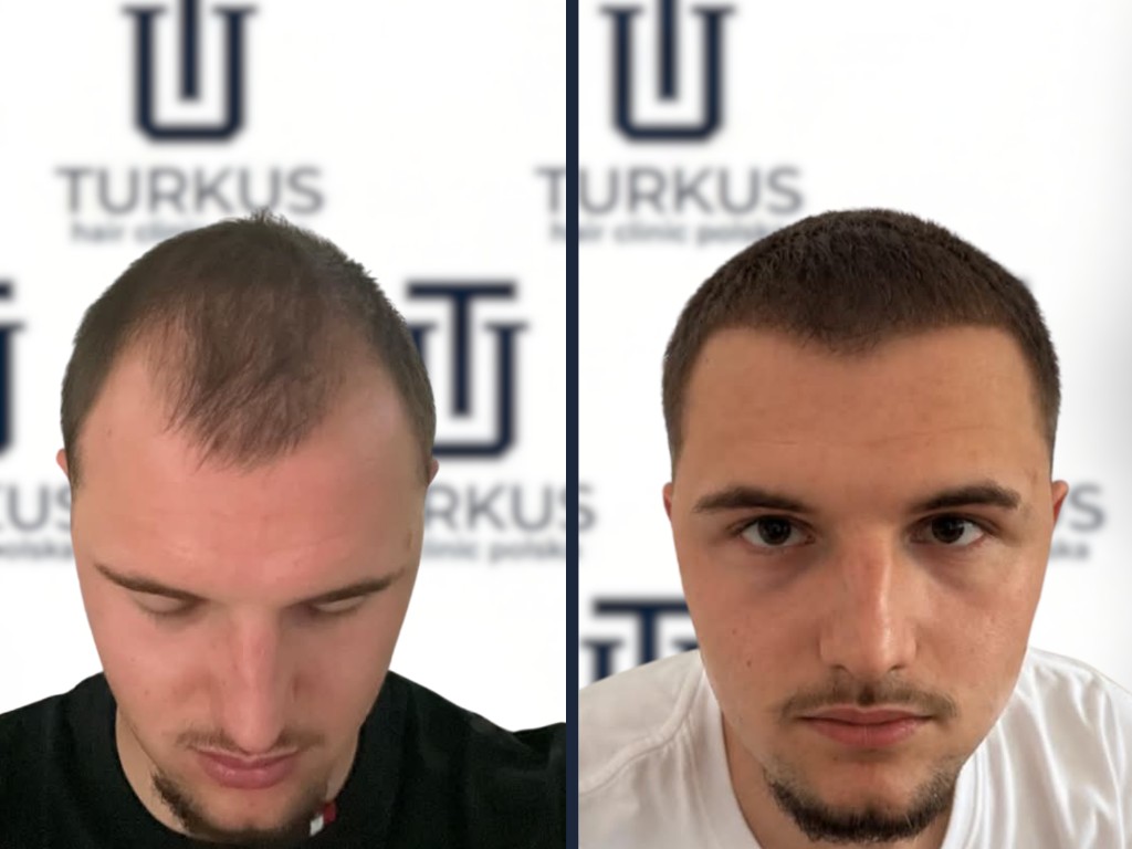 Michał T. przed i po przeszczepie włosów FUE, 3.600 graftów, Norwood 4 w Turkus Hair Transplant Clinic.
