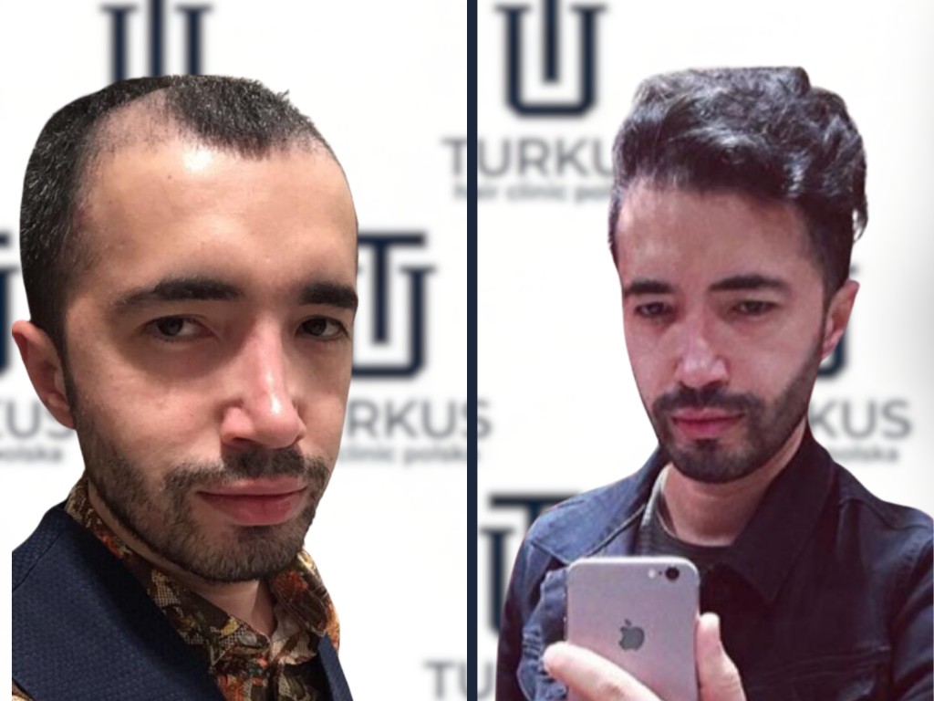 Pablo M. przed i po przeszczepie włosów FUE, 3.800 graftów, Norwood 4 w Turkus Hair Transplant Clinic.