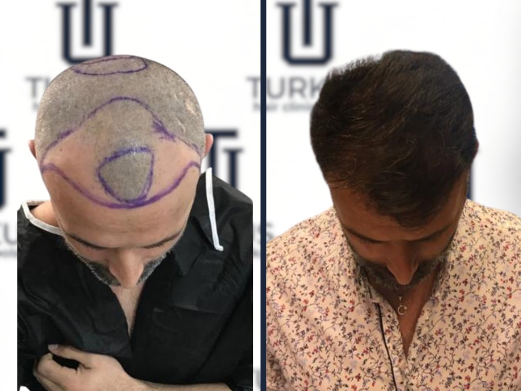 Diego R. przed i po przeszczepie włosów FUE, 4.300 graftów, Norwood 5, widok z góry w Turkus Hair Transplant Clinic.