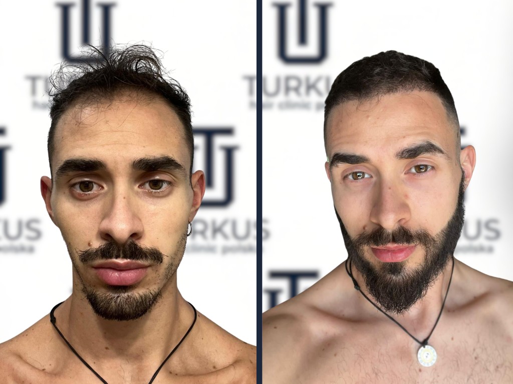 Oskar N. przed i po przeszczepie włosów DHI, 3.200 graftów, Norwood 3 w Turkus Hair Transplant Clinic.