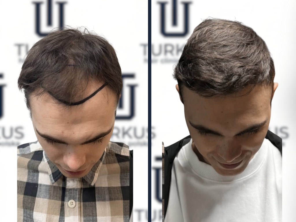 Hubert Z. przed i po przeszczepie włosów FUE, 4.250 graftów, Norwood 5, widok z góry w Turkus Hair Transplant Clinic.