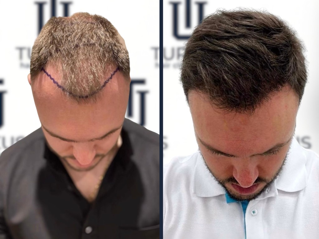 Jacek A. przed i po przeszczepie włosów FUE, 3.850 graftów, Norwood 4, widok z góry w Turkus Hair Transplant Clinic.