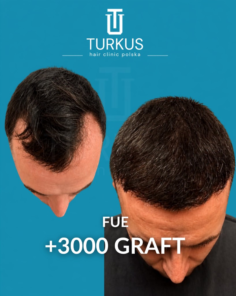 Tomasz R. przed i po przeszczepie włosów FUE, 3.000 graftów, Norwood 4 w Turkus Hair Transplant Clinic.