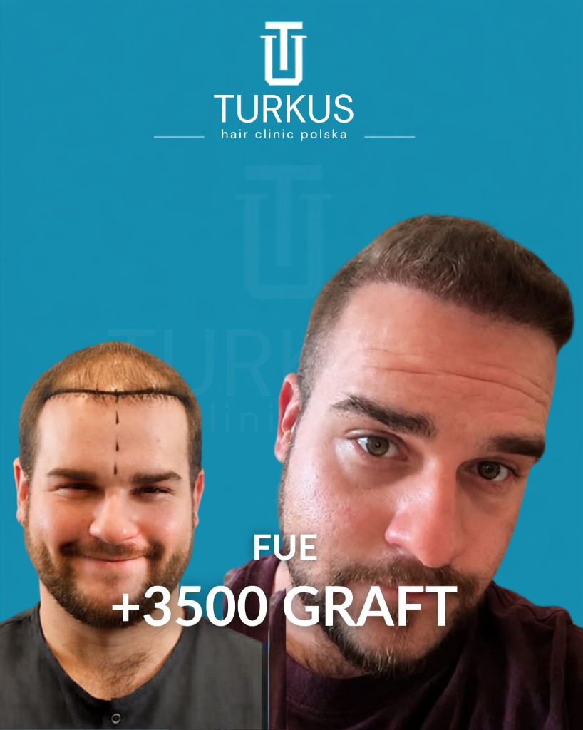 Marcin P. przed i po przeszczepie włosów FUE, 3.500 graftów, Norwood 4 w Turkus Hair Transplant Clinic.