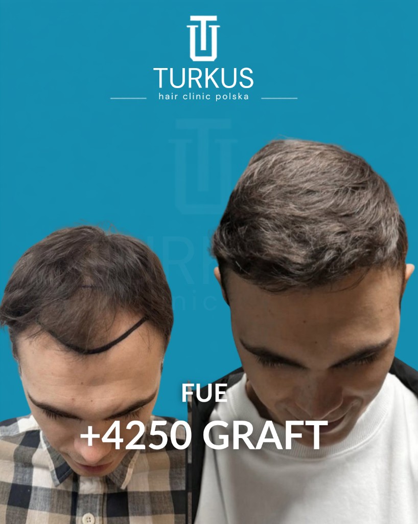 Bartosz K. przed i po przeszczepie włosów FUE, 4.250 graftów, Norwood 5 w Turkus Hair Transplant Clinic.