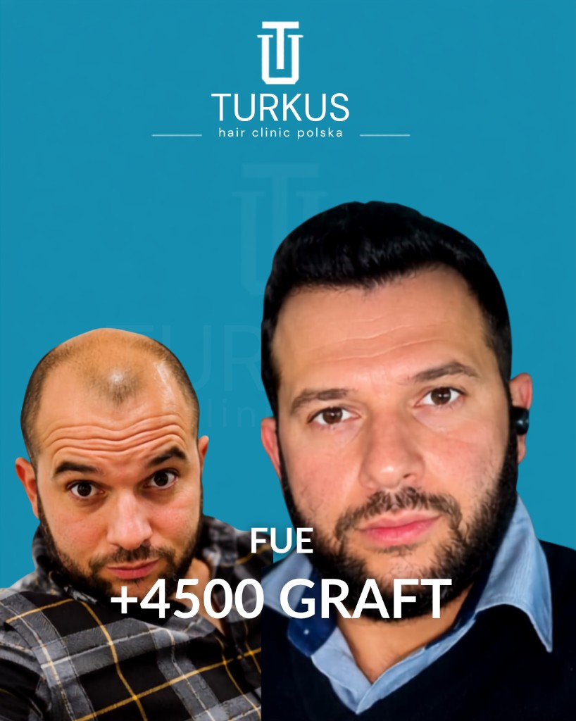 Grzegorz L. przed i po przeszczepie włosów FUE, 4.500 graftów, Norwood 5 w Turkus Hair Transplant Clinic.