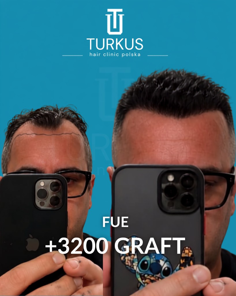 Wiktor S. przed i po przeszczepie włosów FUE, 3.200 graftów, Norwood 3 w Turkus Hair Transplant Clinic.