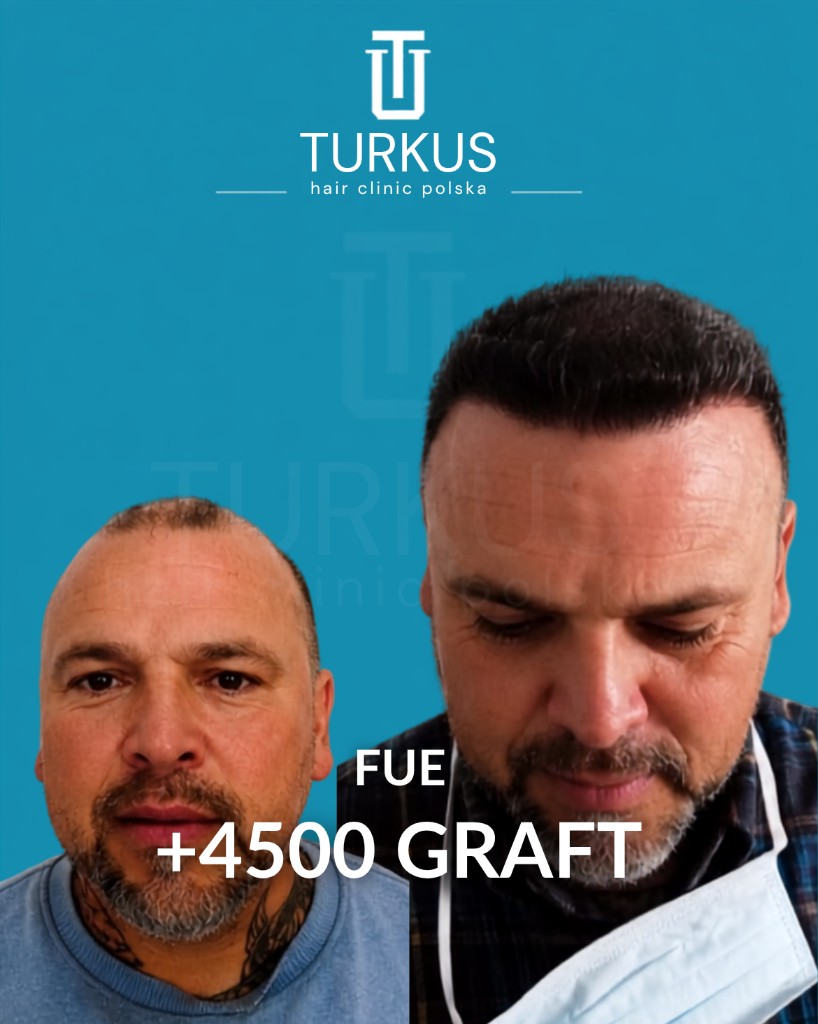 Maciej D. przed i po przeszczepie włosów FUE, 4.500 graftów, Norwood 6 w Turkus Hair Transplant Clinic.