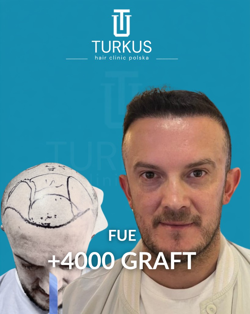 Dawid P. przed i po przeszczepie włosów FUE, 4.000 graftów, Norwood 5 w Turkus Hair Transplant Clinic.