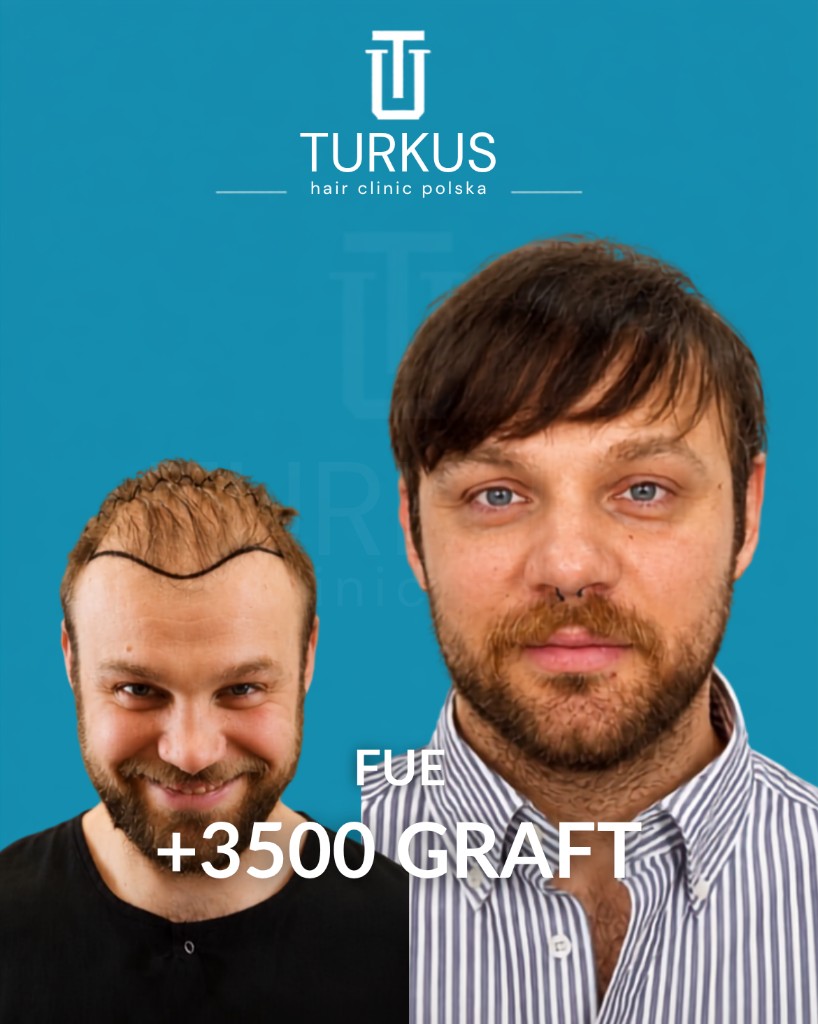 Sebastian W. przed i po przeszczepie włosów FUE, 3.500 graftów, Norwood 4 w Turkus Hair Transplant Clinic.