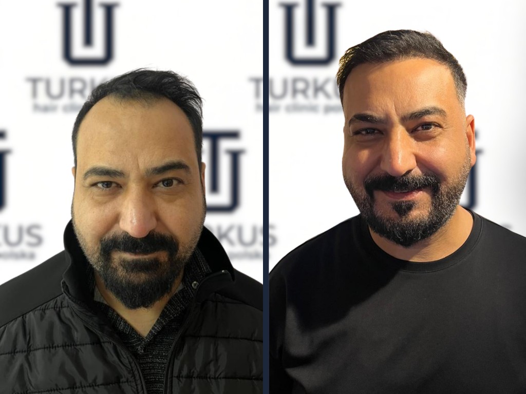 Emre K. przed i po przeszczepie włosów FUE, 3.750 graftów w Turkus Hair Transplant Clinic.