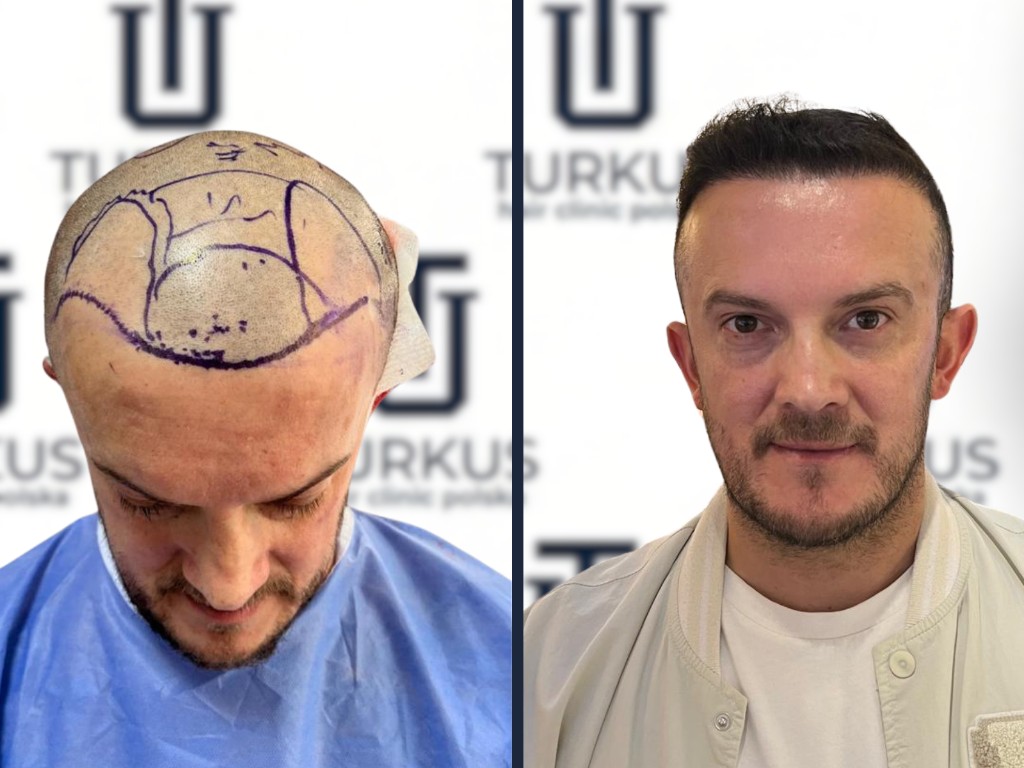 Filip W. przed i po przeszczepie włosów FUE, 4.000 graftów w Turkus Hair Transplant Clinic.