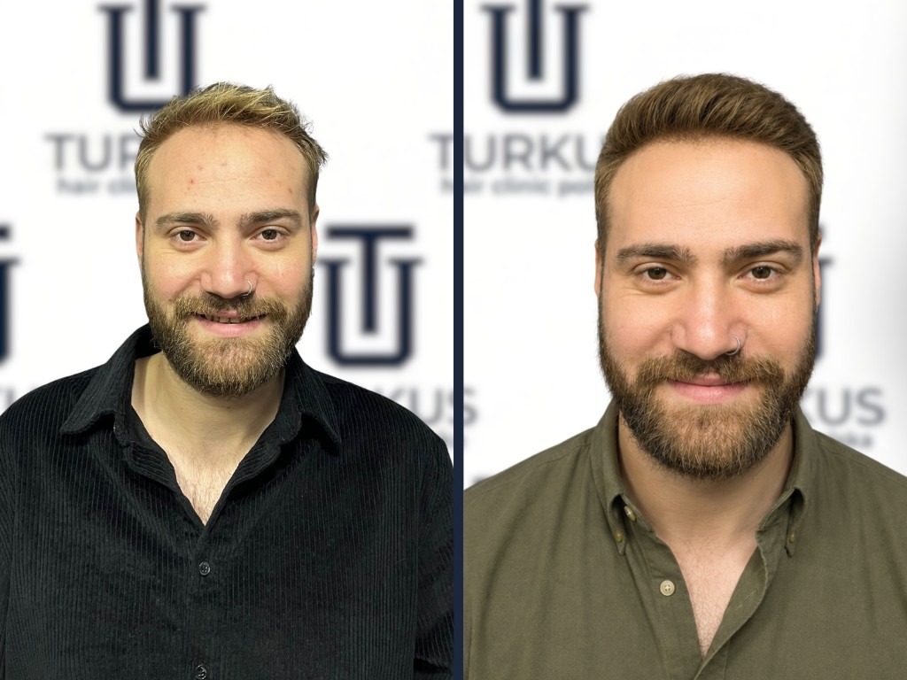 Piotr M. przed i po przeszczepie włosów FUE w Turkus Hair Transplant Clinic.