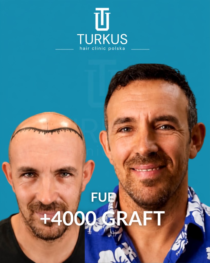 Efekt przed i po przeszczepie FUE (+4000 graftów) na jednolitym niebieskim tle studia Turkus.