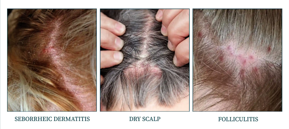 Zbliżenia łojotokowego zapalenia, suchej skóry głowy i zapalenia mieszków.