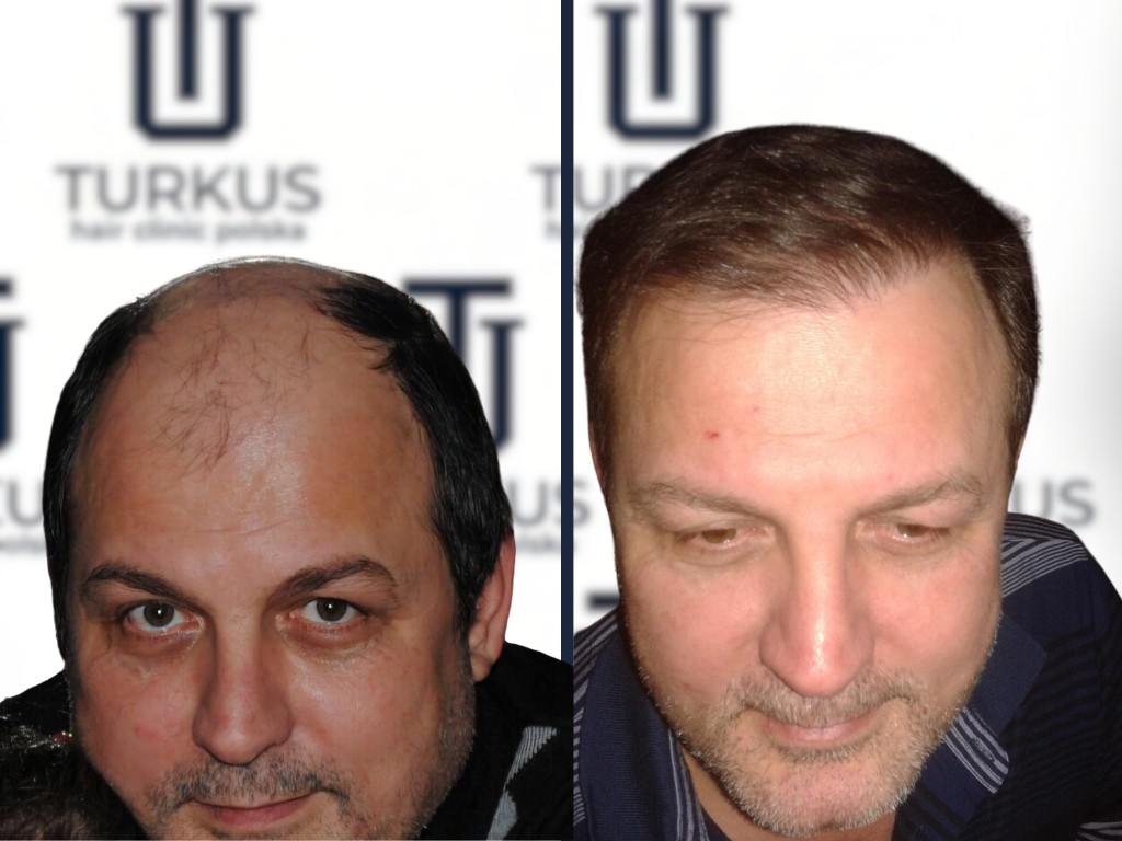 Efekt przed i po przeszczepie włosów w Turkus na niebieskim tle studia pokazujący poprawioną gęstość.