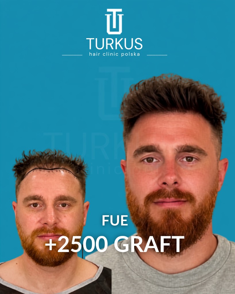 Efekt przed i po przeszczepie FUE (+2500 graftów) na jednolitym niebieskim tle studia Turkus.