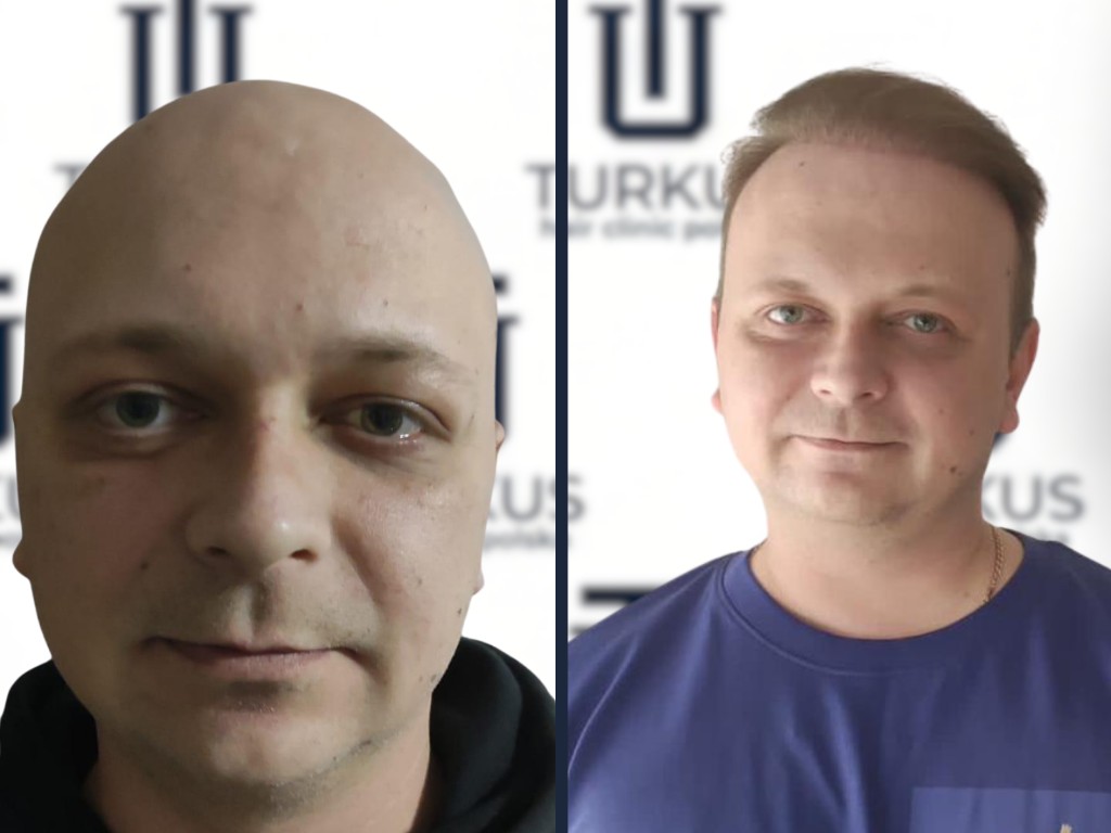 Efekt przed i po przeszczepie w Turkus pokazujący odbudowaną gęstość z przodu na niebieskim tle studia.