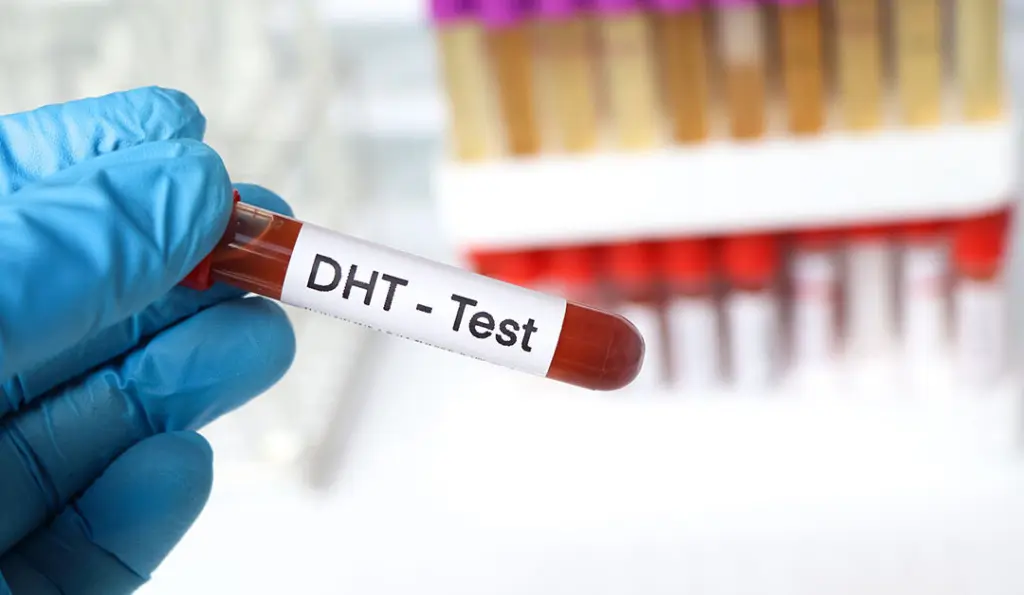 Próbówka laboratoryjna do testu DHT związanego z androgenoczułym wypadaniem włosów.