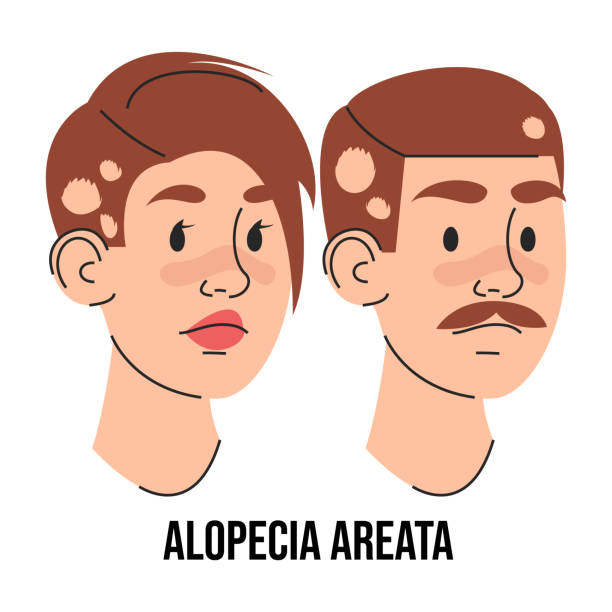 Ilustracja łysienia plackowatego z wieloma okrągłymi łyżynami na skórze głowy.