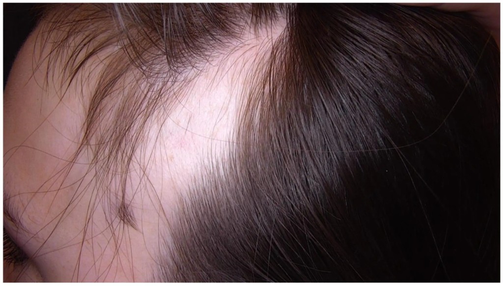 Alopecia trójkątna: przyczyny, leczenie i czy się rozszerza?