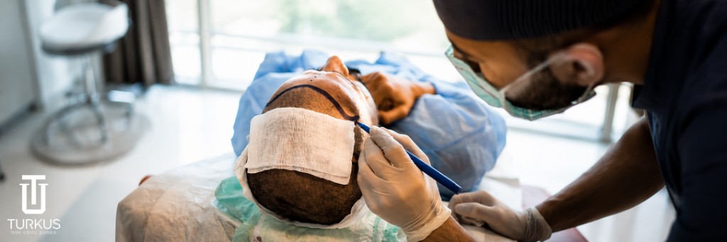 Specjalista zaznacza linię włosów przed przeszczepem DHI w Turkus Hair Transplant Clinic, Warszawa.