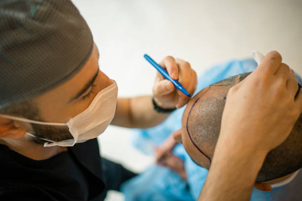 Etapy zabiegu DHI, zespół transplantacji w Turkus Hair Transplant Clinic w Warszawie.