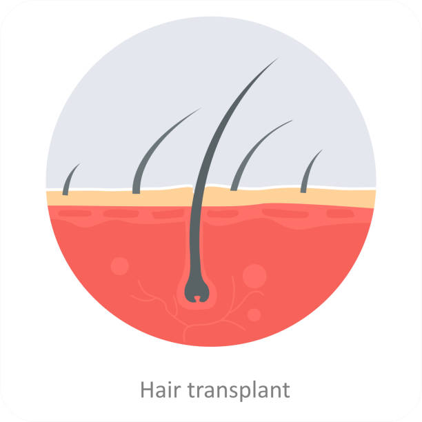 Konsultacja przeszczepu włosów w Turkus Hair Transplant Clinic, plan zabiegu bez golenia.