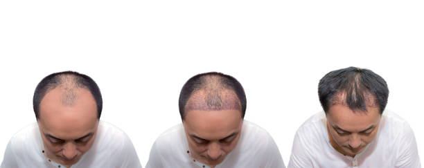 Konsultacja przeszczepu bez golenia, dyskretna odbudowa w Turkus Hair Transplant Clinic.