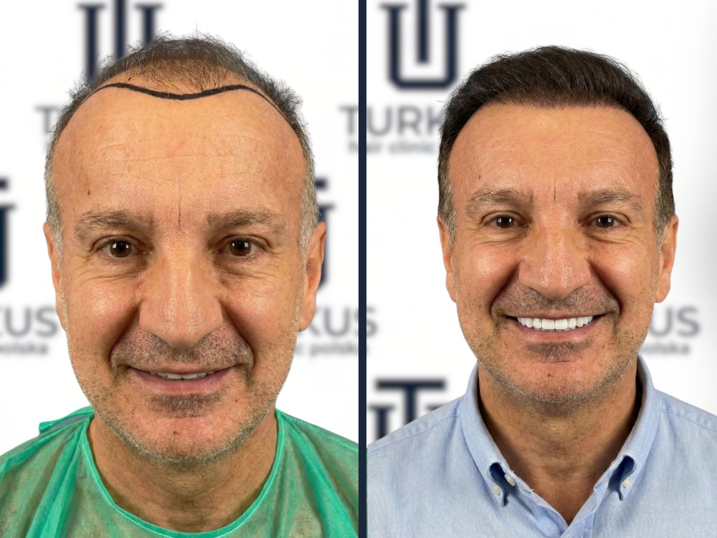 DHI w skrócie, naturalna linia włosów i technika implanter.