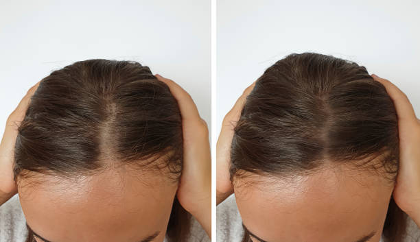 Plan liczby graftów przy przeszczepie u kobiet w Turkus Hair Transplant Clinic.
