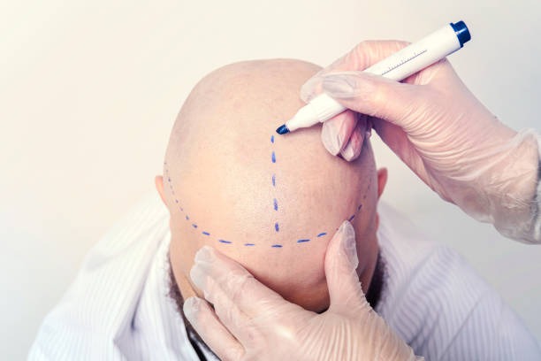 Projekt brwi, naturalny kształt i łuk w Turkus Hair Transplant Clinic.