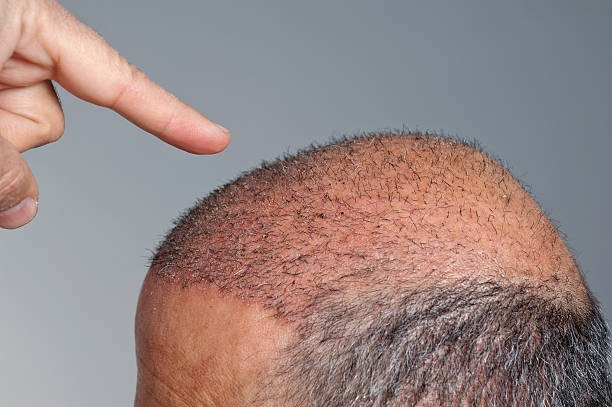 Konsultacja kosztu transplantacji brwi w Polsce, Turkus Hair Transplant Clinic.