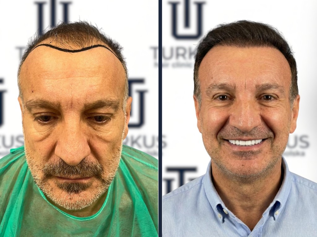 Konsultacja przeszczepu włosów w Turkus Hair Transplant Clinic, plan leczenia FUE.