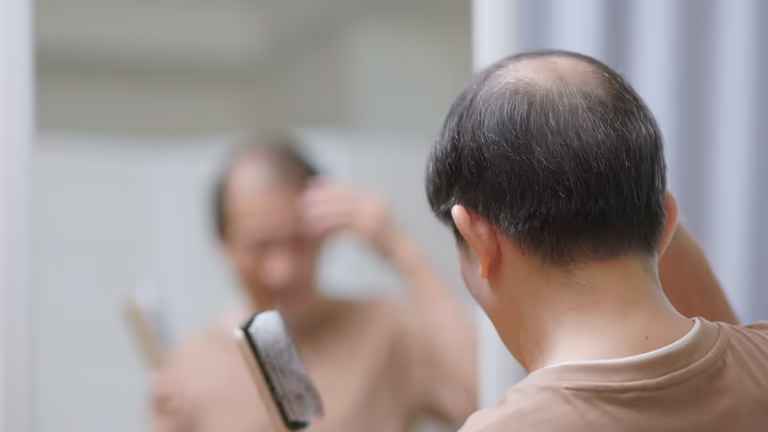 Konsultacja wypadania włosów w Turkus Hair Transplant Clinic, Warszawa, planowanie leczenia.