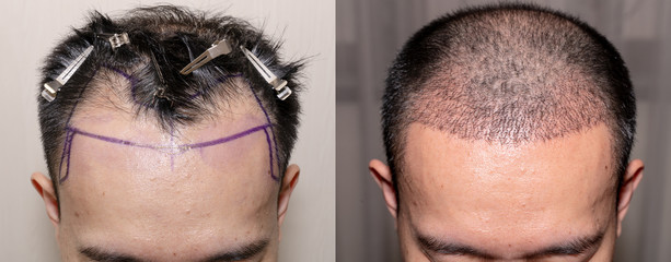 Wczesna opieka po przeszczepie włosów, wprowadzenie do pielęgnacji w Turkus Hair Transplant Clinic, Warszawa.