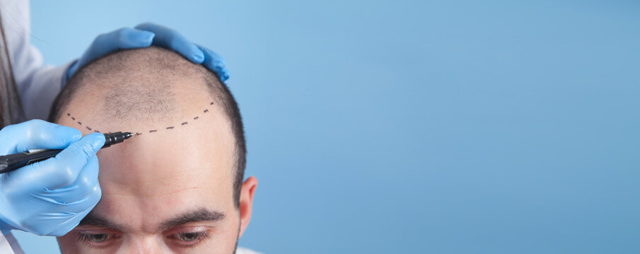 Projektowanie naturalnej linii włosów przed przeszczepem w Turkus Hair Transplant Clinic.